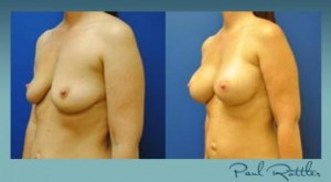 38 YO Female, Left Side Angle Breast Augmentation, St. Louis, Photo 39 YO Female, Left Side Angle Breast Augmentation, St. Louis, Photo - Paul Rottler, MD, FACS