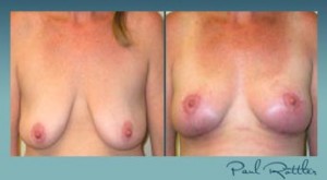 43 YO Female, Front Angle Breast Lift, St Louis, Photo 43 YO Female, Front Angle Breast Lift, St Louis, Photo - Image URL