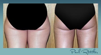Medial And Lateral Thighs Liposuction, St. Louis Patient Before And After Photos Medial And Lateral Thighs Liposuction, St. Louis Patient Before And After Photos - Medial And Lateral Thighs Liposuction, St. Louis Patient Before And After Photos