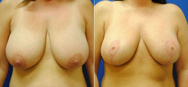 Before & After Breast Reduction Photos