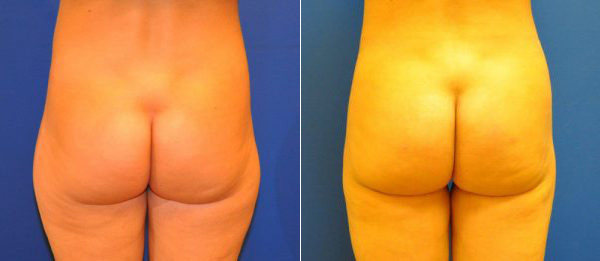 Before & After Liposuction Photos