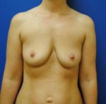 Saline Breast Augmentation