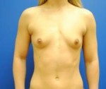 Saline Breast Augmentation