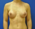 Saline Breast Augmentation