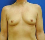 Saline Breast Augmentation