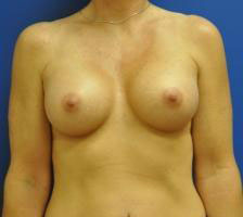 Saline Breast Augmentation