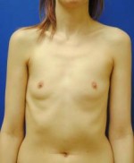 Saline Breast Augmentation