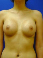 Saline Breast Augmentation