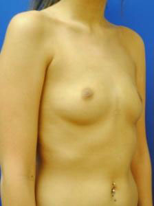 Saline Breast Augmentation