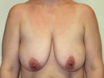 Breast Lift