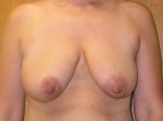 Breast Lift