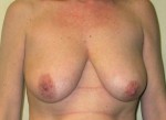 Breast Lift