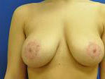 Breast Enhancement (Breast Lift with Implants)