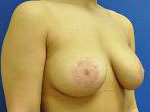 Breast Enhancement (Breast Lift with Implants)