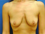 Breast Enhancement (Breast Lift with Implants)