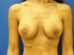 Breast Enhancement (Breast Lift with Implants)