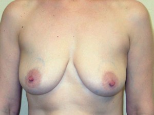 Breast Enhancement (Breast Lift with Implants)