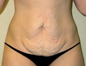 Tummy Tuck Case 3703 Before Photo Tummy Tuck