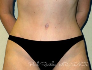 Tummy Tuck Case 3703 After Photo Tummy Tuck