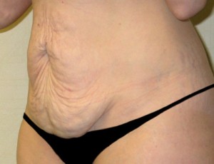 Tummy Tuck Case 3703 Before Photo Tummy Tuck