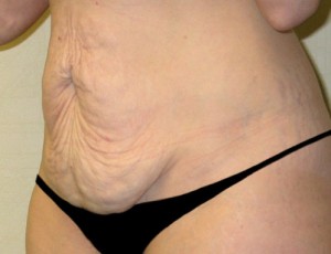 Tummy Tuck