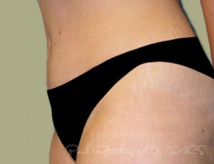 Tummy Tuck Case 3703 After Photo Tummy Tuck
