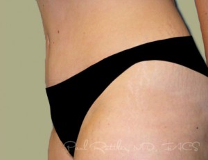 Tummy Tuck