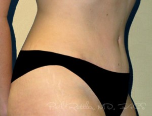 Tummy Tuck Case 3703 After Photo Tummy Tuck