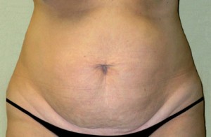 Tummy Tuck