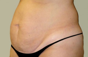 Tummy Tuck