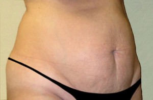 Tummy Tuck