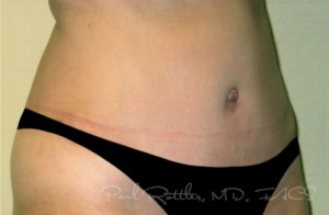 Tummy Tuck