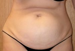 Tummy Tuck