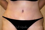 Tummy Tuck