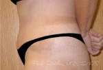Tummy Tuck