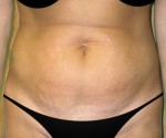 Tummy Tuck