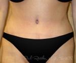 Tummy Tuck