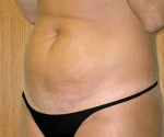 Tummy Tuck