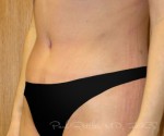 Tummy Tuck