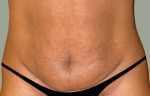 Tummy Tuck