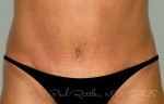 Tummy Tuck