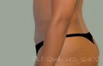 Tummy Tuck