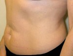 Tummy Tuck
