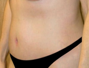 Tummy Tuck