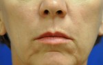 Dermal Filler