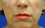 Dermal Filler