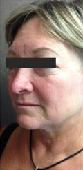 Dermal Filler