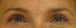 Blepharoplasty