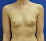 Silicone Breast Augmentation