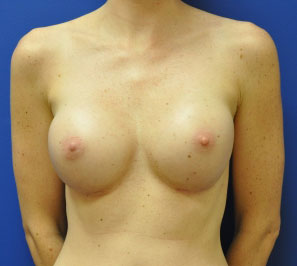 Silicone Breast Augmentation